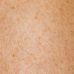 Image of fair skin with freckles